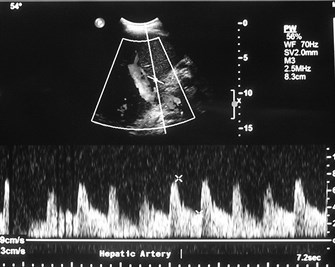 hepatic artery doppler before